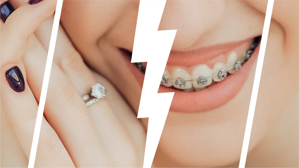Image for the pros and cons list Braces